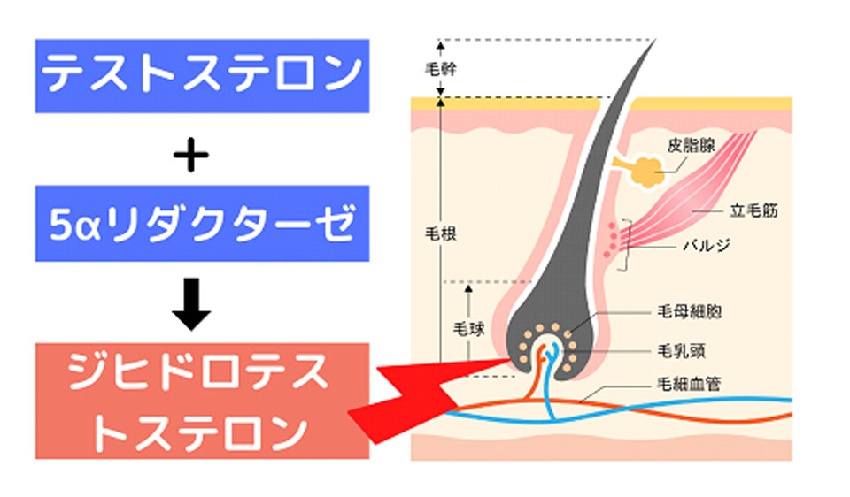 AGAはなぜ進行するの？