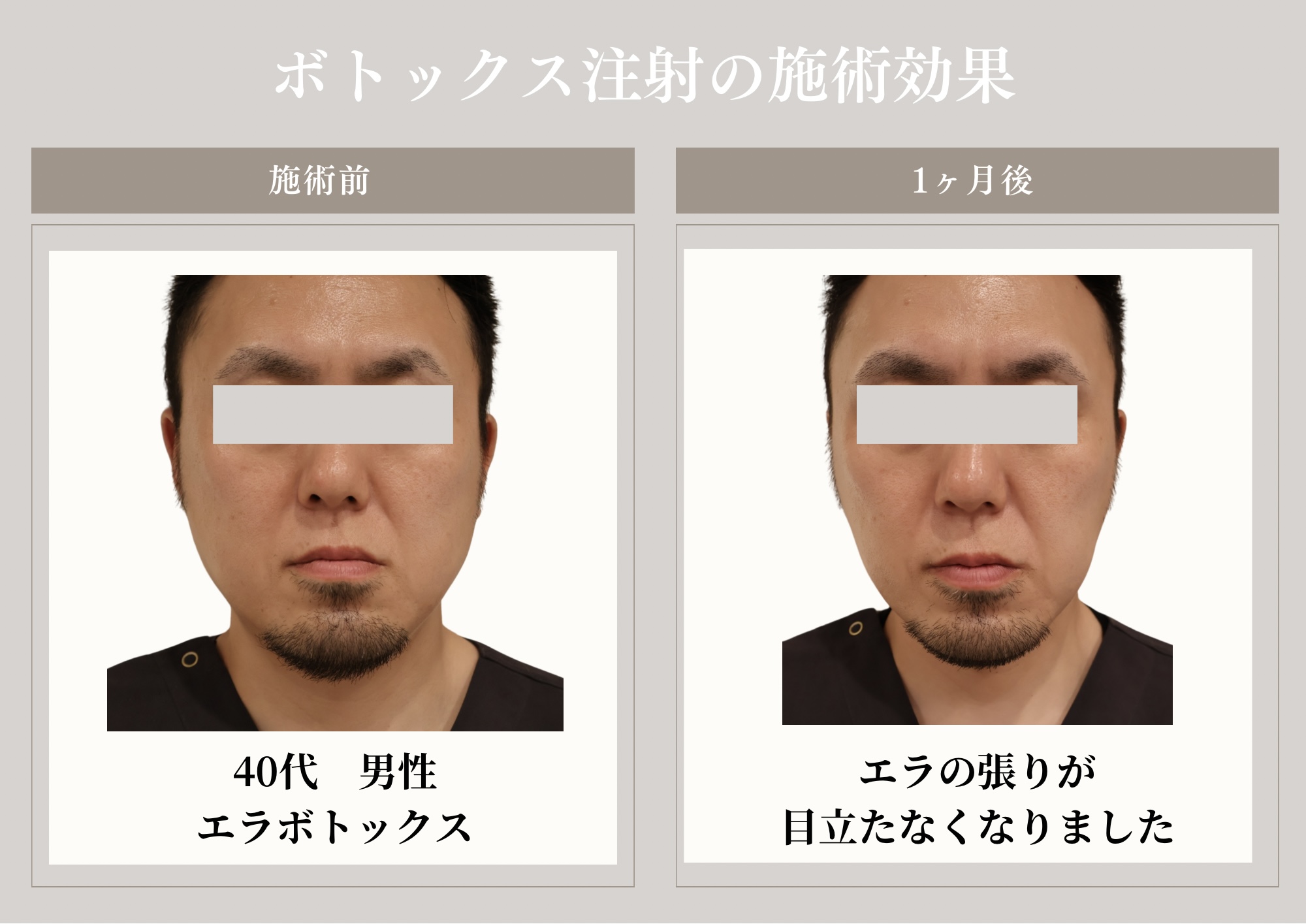 ボトックス注射 症例写真 効果比較