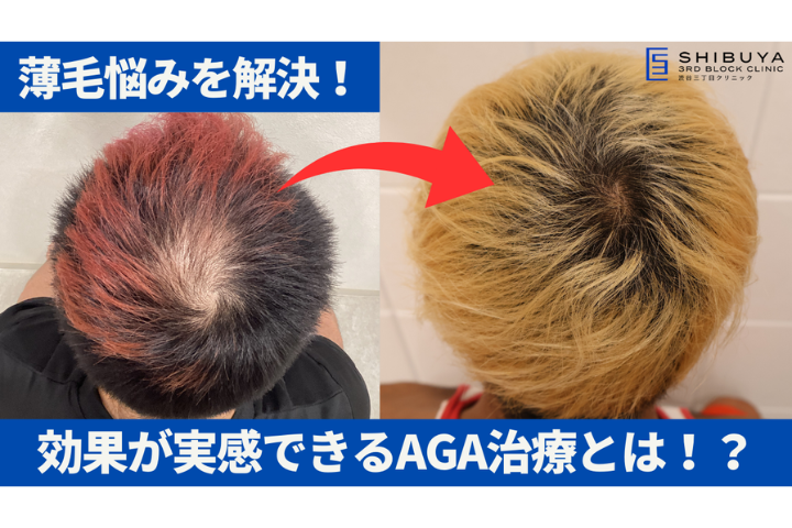 【医師解説】AGA治療の全記録！モニター症例写真で見る9か月間の結果