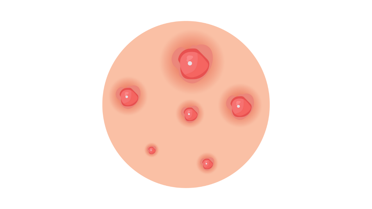 腫れ