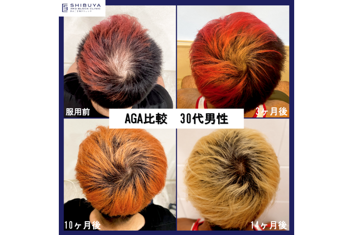 【AGA】モニター症例